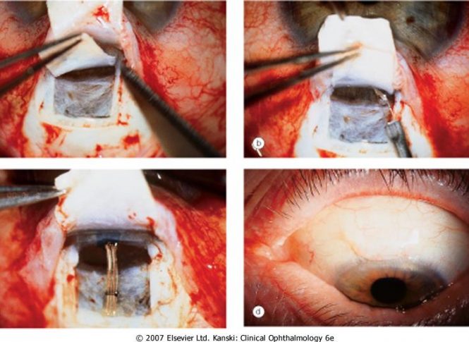 cirurgia glaucoma cirurgia glaucoma